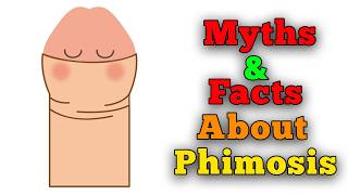 Myths And Facts About Phimosis Tight Foreskin [upl. by Notsirb967]