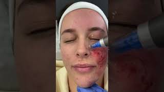 Microneedling with Dermapen 4 at DRMEDISPA [upl. by Ayyn]