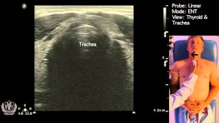 Thyroid amp Trachea Ultrasound [upl. by Dulce]