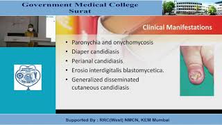 Opportunistic Fungal Infections [upl. by Phelps]