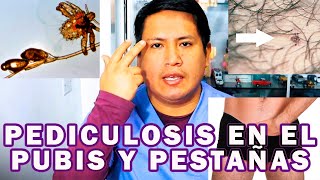 COMO ELIMINAR LA PEDICULOSIS EN EL PUBIS Y PESTAÑAS [upl. by Schertz656]