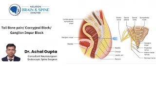 Tail bone pain Coccygeal block Ganglion Impar block  Dr Achal Gupta  Neuro amp Spine Surgeon [upl. by Bellaude]