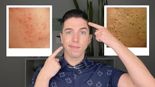 How to Get Rid of Acne Scars [upl. by Gillette]