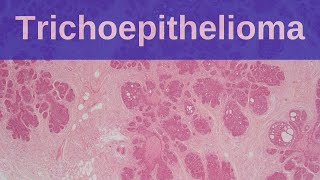 Trichoepithelioma  Pathology mini tutorial [upl. by Lekar]