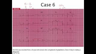 29 EKG ectopic atrial rhythm  ករណីសិក្សារលើការរៀនអាន ECG លើអ្នកជំងឺមាន ectopic atrial rhythm [upl. by Celestyn915]