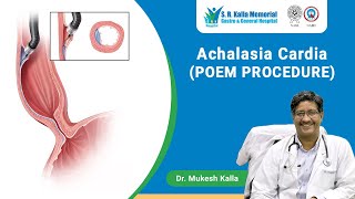 Achalasia Cardia Poem Surgery Tips Given By Dr Mukesh Kalla gastroenterologist [upl. by Aiykan585]