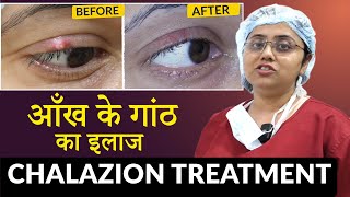 पलक की गाँठ का इलाज  Chalazion क्लेजियन Treatment  Eyelid Cyst Removal Procedure [upl. by Mandle676]