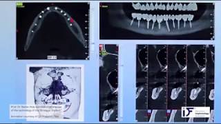 Dr Ihde Comments on Use of Strategic Implant® in CorticoBasal Implantology  Simpladent India [upl. by Anitnuahs]