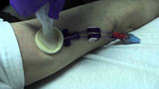 Roughest Picc Line Removal Ever  HD [upl. by Ehcram]