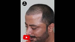 Best Hair Transplant in Jodhpur jodhpurhairtransplant hairtransplantinjodhpur iftclinic [upl. by Anasus825]