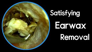 ASMR Immersive Earwax Removal On Weekend [upl. by Rehportsirhc]