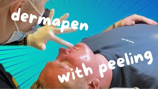 DERMAPEN WITH PEELING [upl. by Vadnee]