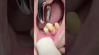 Extraction of upper first premolar tooth with mobility dentist smilteethcare teethwhitening [upl. by Anaibaf]