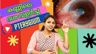 Pterygium explained കണ്ണിലെ ദശ വളർച്ചയെപറ്റി നിങ്ങൾ അറിയേണ്ടത് health eyecondition education [upl. by Haela]