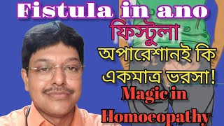 ফিস্টুলা  Fistula  হোমিওপ্যাথি ঔষধ  Fistula Treatment Homeopathy Bangla  Anal Fistula Medicine [upl. by Orfield]