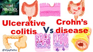 Ulcerative colitis Vs Crohns disease inflammatoryboweldisease [upl. by Nat]