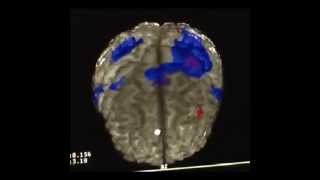 Kinesio effect on cortical brain activity fMRI [upl. by Leanatan]