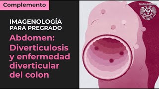 ¿Qué es la enfermedad diverticular [upl. by Llevram]