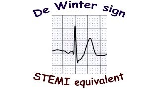 De Winter sign [upl. by Michaeu]