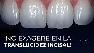 ¡No exagere en la translucidez incisal [upl. by Anileh]