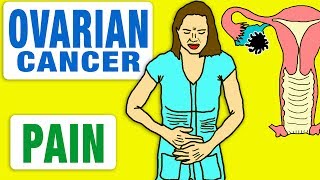 Ovarian cancer pain [upl. by Aenej456]