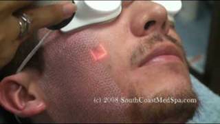 Active FX Laser Acne Scars Removal [upl. by Eelah203]