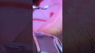 Deep Tonsil Stone Removal  Tonsil Stones  Tooth Time Family Dentistry New Braunfels Texas [upl. by Mika]