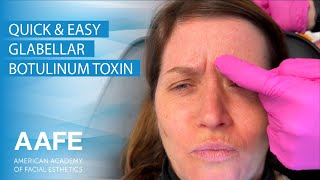 Quick amp Easy Glabellar Botulinum Toxin Injection [upl. by Allemaj597]