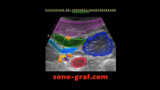 Sonographie  Cholestase bei Pankreaskopf Raumforderung [upl. by Ahsiuqram845]