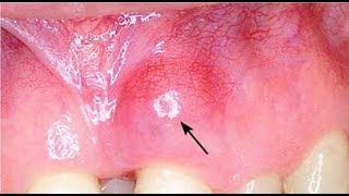 how to get rid of abscess on gum at home [upl. by Arvid]