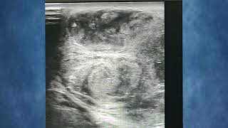 Testicular Abscess Complicated EpididymoOrchitis infection medical health ultrasound trending [upl. by Yeleak816]