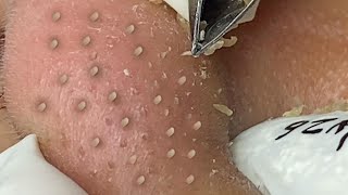 Satisfying With Loan Nguyen Spa Video 061 acnetreatment [upl. by Peti]