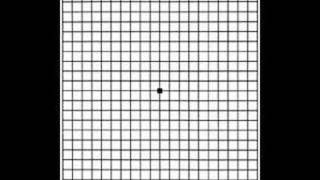 Grid for Macular Degeneration [upl. by Thatch]