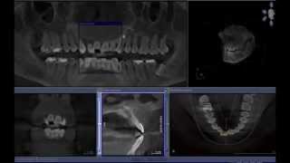 Nasopalatine Duct Cyst  Cone beam computed tomography [upl. by Enrol569]