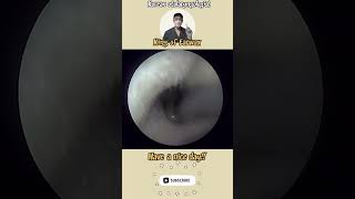 귀지형 콧물 부비동염 축농증 비염 코청소 이비인후과 rhinorrhea rhinitis sinusitis asmr [upl. by Ahsenev]