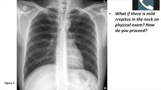 Thoracic Surgery Didactics—Esophageal Perforation [upl. by Owiat]