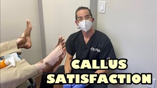 EXTENSIVE REMOVAL OF HUGE PLANTAR CALLUSES [upl. by Elli]