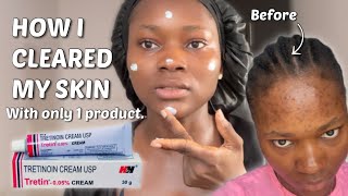 THE TRETINOIN NIGHT ROUTINE THAT CLEARED MY SKIN  Step by step Tretinoin routine tretinoin [upl. by Prentice520]