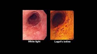 Barrets Esophagus  Clinical Features [upl. by Claiborn864]