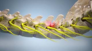 Thermal radiofrequency ablation [upl. by Laehpar93]