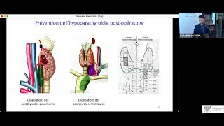 04 Hypoparathyroïdie définitive après thyroïdectomie [upl. by Leelah922]