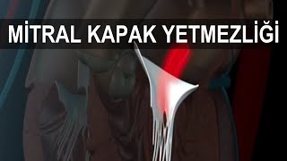 Mitrak Kapak Yetmezliği [upl. by Hippel]