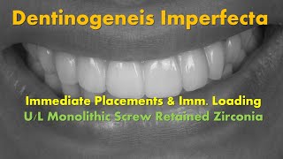 Dentinogenesis Imperfecta Full Arch Immediate Placements amp Loading [upl. by Crispas]