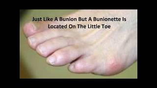 Bunionette Pictures Tailors Bunion Tailors Toe Photos [upl. by Blalock183]