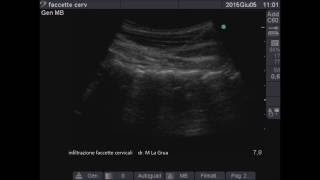 Ultrasoundguided cervical facet joint injection [upl. by Ellehctim]