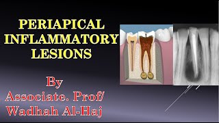 4 Periapical lesions Dr Wadhah Oral Pathology lectures د وضاح الحاج [upl. by Aivatra]