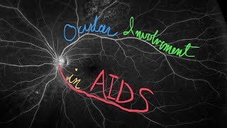 Ocular Involvement in AIDS [upl. by Hymen]