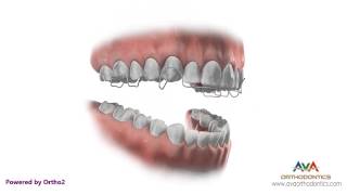 Orthodontic Retainer  Hawley  Instruction and Care [upl. by Aseel]