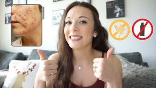 I Went GLUTEN amp DAIRYFREE for My Hormonal ACNE  Skin Update [upl. by Ahsenrad487]