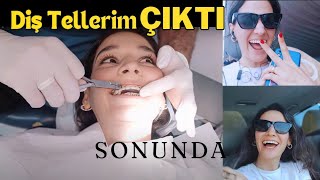 Sonunda Diş Tellerim Çıktı  Retainer amp Şeffaf Plak Dönemi [upl. by Ahseret]